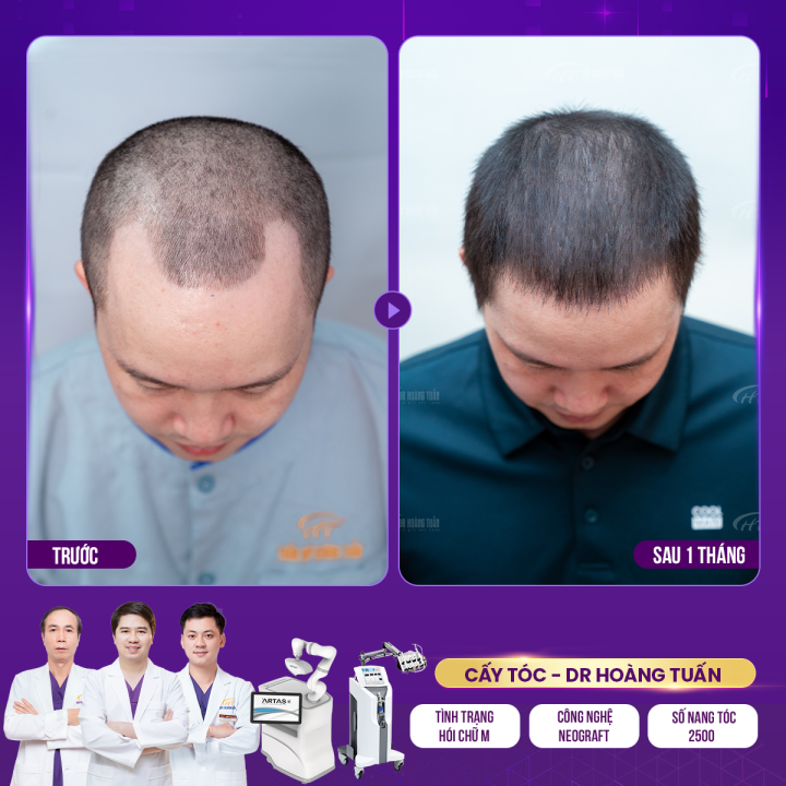 Cấy Tóc Hói Tại Hoàng Tuấn – Phục Hồi Mái Tóc Hết Hói Chỉ Sau 1 Liệu Trình